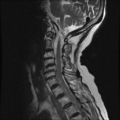 Anterior spinal artery syndrome (Radiopaedia 46335-50750 A 6).png