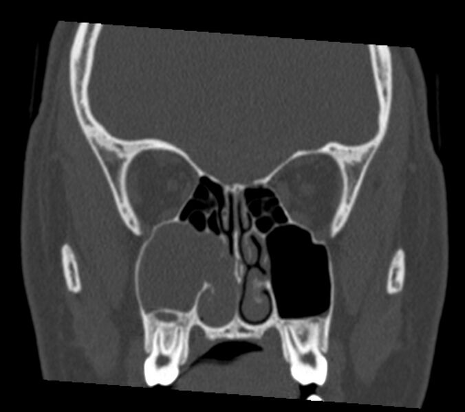 File:Antrochoanal polyp (Radiopaedia 21894-21868 Coronal bone window 17).jpg