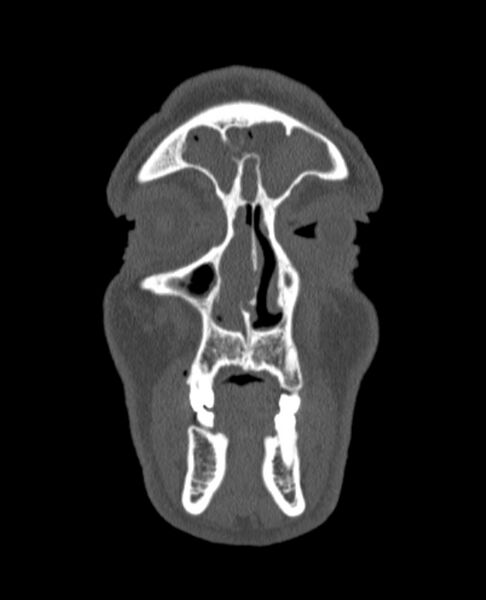 File:Antrochoanal polyp (Radiopaedia 79011-92169 Coronal bone window 74).jpg