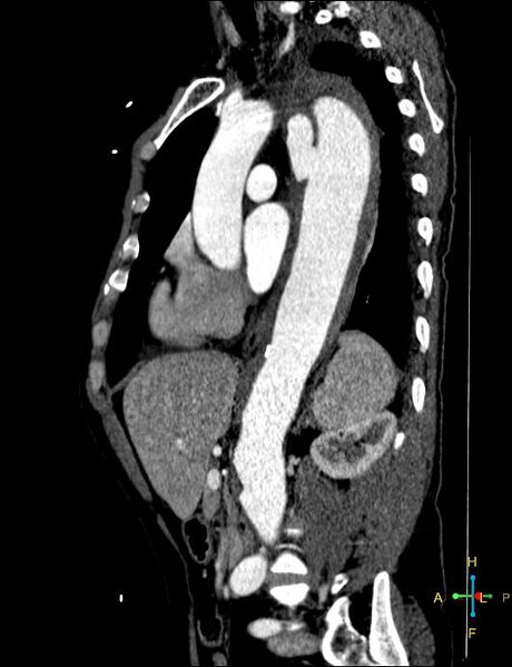 File:Aortic aneurysm and penetrating ulcer (Radiopaedia 23590-23704 C 17).jpg