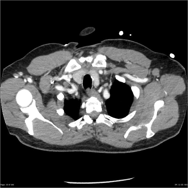 File:Aortic dissection- Stanford A (Radiopaedia 37759-39664 A 1).jpg