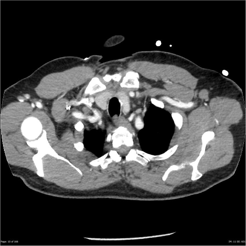 Aortic dissection- Stanford A (Radiopaedia 37759-39664 A 1).jpg