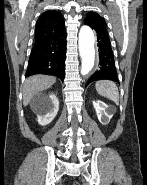 File:Aortic dissection (Radiopaedia 44411-48061 A 50).jpg