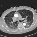 Aortic dissection - DeBakey type II (Radiopaedia 64302-73082 Axial lung window 26).png