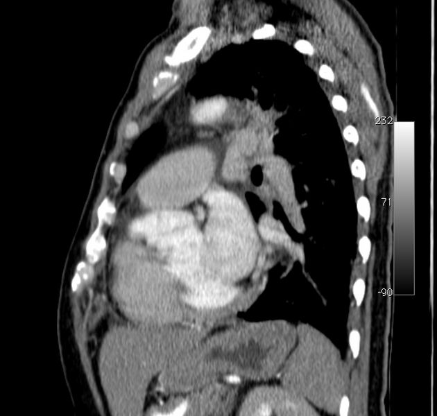 File:Aortic dissection - Stanford type A (Radiopaedia 29247-29659 C 17).jpg