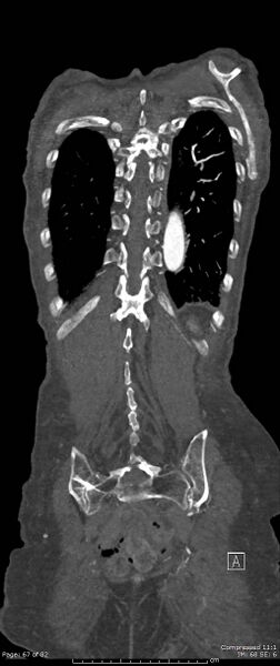 File:Aortic dissection with extension into aortic arch branches (Radiopaedia 64402-73204 A 67).jpg