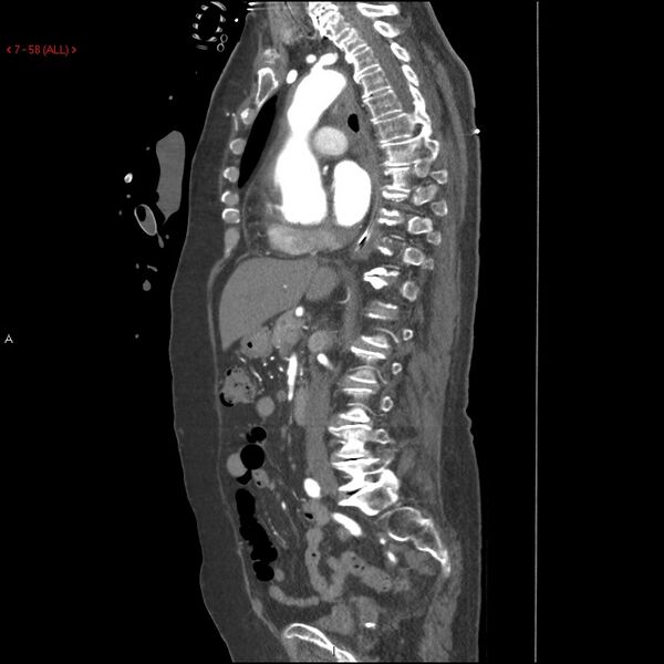 File:Aortic intramural hematoma (Radiopaedia 27746-28001 C 27).jpg