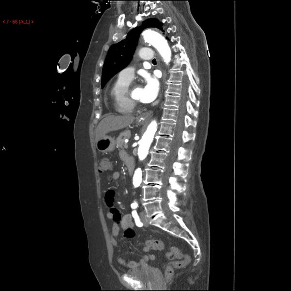 File:Aortic intramural hematoma (Radiopaedia 27746-28001 C 35).jpg