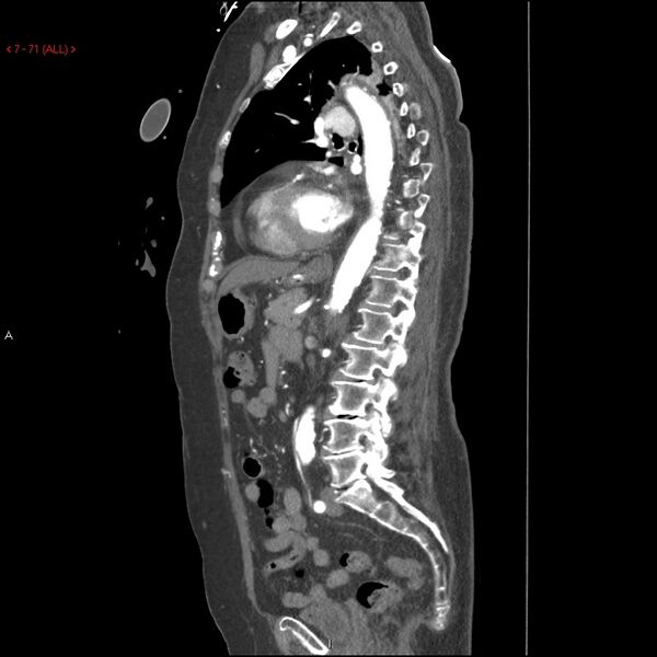 File:Aortic intramural hematoma (Radiopaedia 27746-28001 C 40).jpg