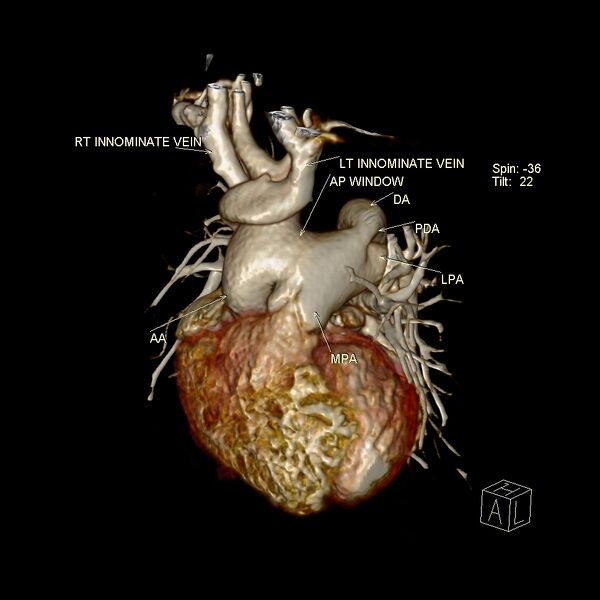 File:Aortopulmonary window, interrupted aortic arch and large PDA giving the descending aorta (Radiopaedia 35573-37077 3D 2).jpg