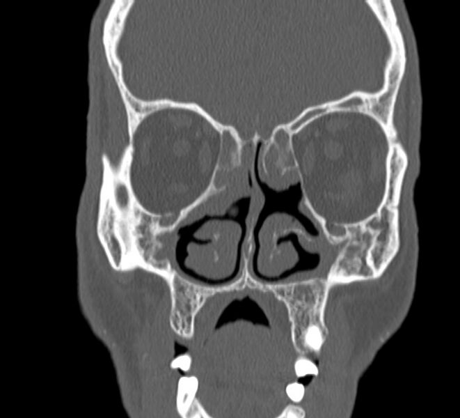 File:Aplastic maxillary sinuses (Radiopaedia 60030-67561 Coronal non-contrast 17).jpg