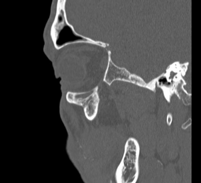 File:Aplastic maxillary sinuses (Radiopaedia 60030-67561 Sagittal bone window 26).jpg