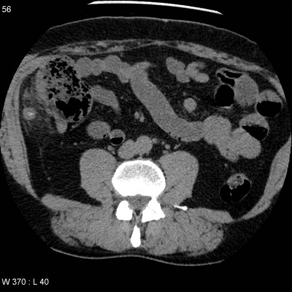 File:Appendicitis (Radiopaedia 12510-12733 Axial non-contrast 23).jpg