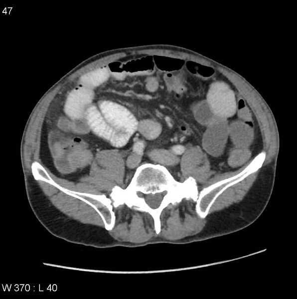 File:Appendicitis (Radiopaedia 27446-27642 A 26).jpg