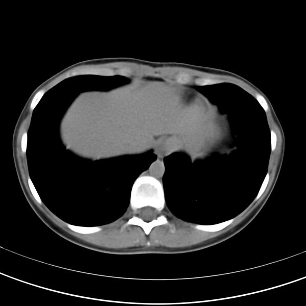 File:Appendicitis and incidental bicornuate uterus (Radiopaedia 22833-22853 Axial non-contrast 6).jpg