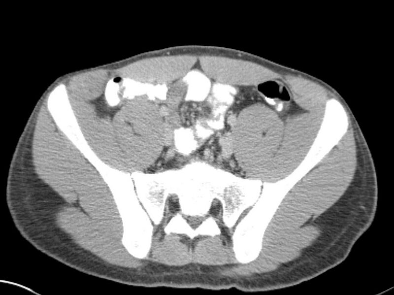 File:Appendicitis and incidental foregut duplication cyst (Radiopaedia 52962-58916 A 70).jpg