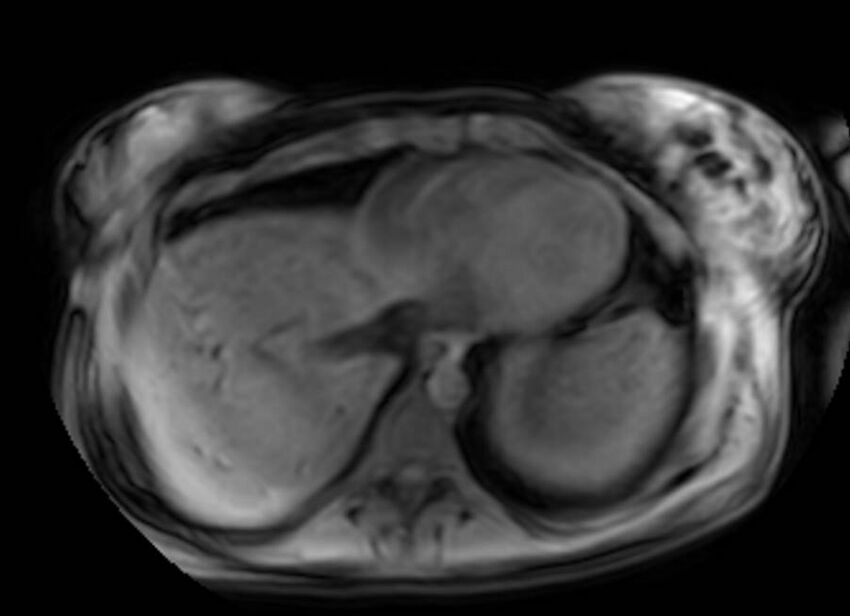 Appendicitis in gravida (MRI) (Radiopaedia 89433-106395 Axial DIXON 3).jpg