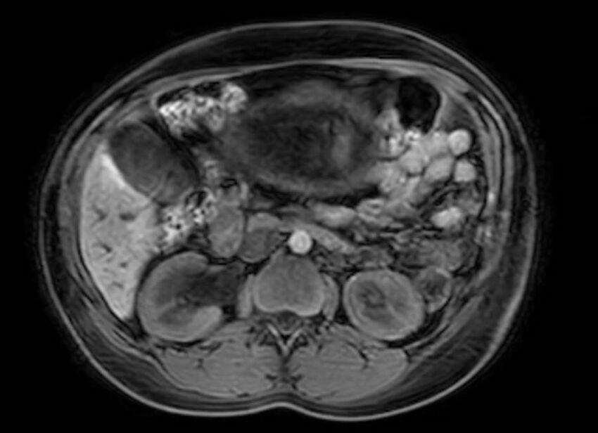 Appendicitis in gravida (MRI) (Radiopaedia 89433-106395 Axial DIXON 53).jpg
