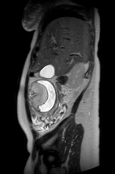 File:Appendicitis in gravida (MRI) (Radiopaedia 89433-106395 Sagittal T2 51).jpg
