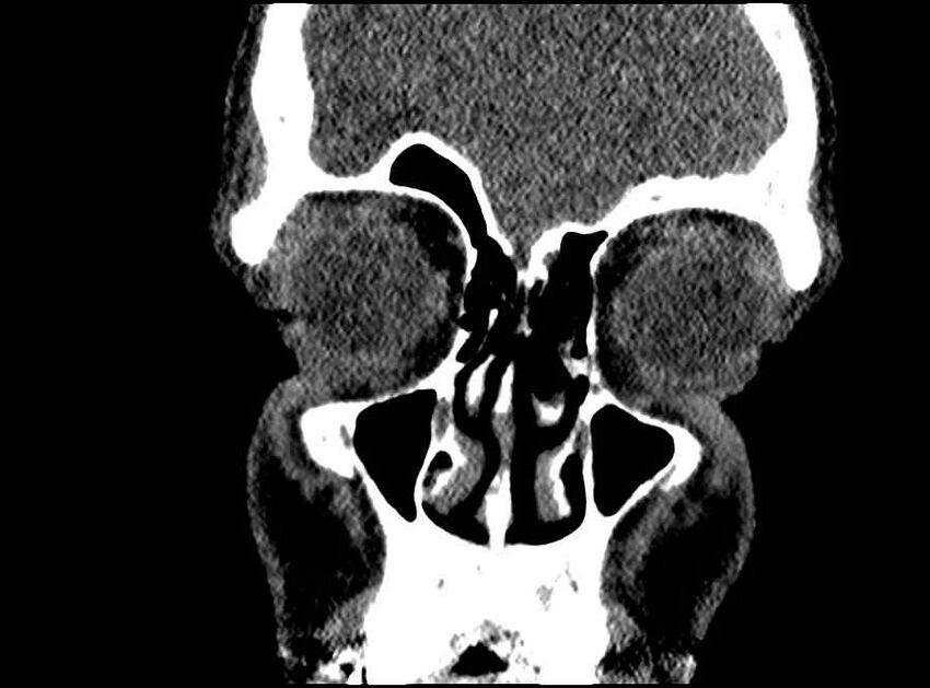 Arachnoid cyst- extremely large (Radiopaedia 68741-78450 Coronal bone window 61).jpg