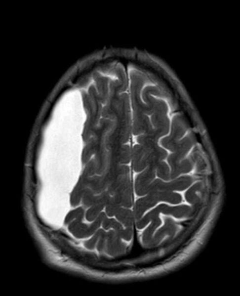 File:Arachnoid cyst- extremely large (Radiopaedia 68741-78451 Axial T2 22).jpg
