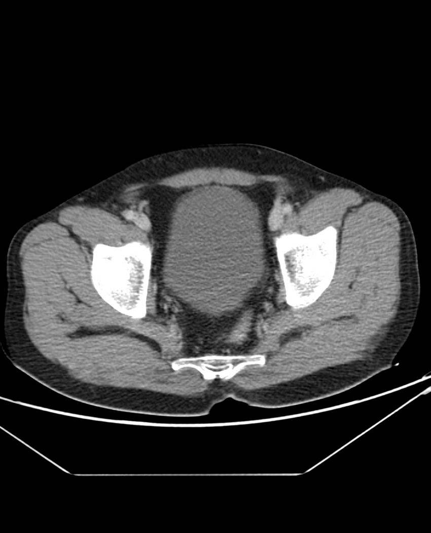 Arterial occlusive mesenteric ischemia (Radiopaedia 84641-100054 A 108).jpg