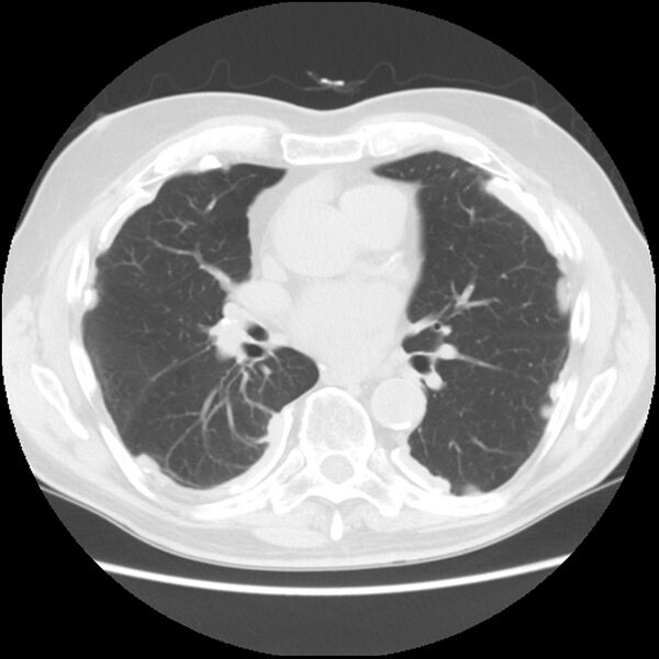 File:Asbestos-related pleural plaques (Radiopaedia 39069-41255 Axial lung window 39).jpg