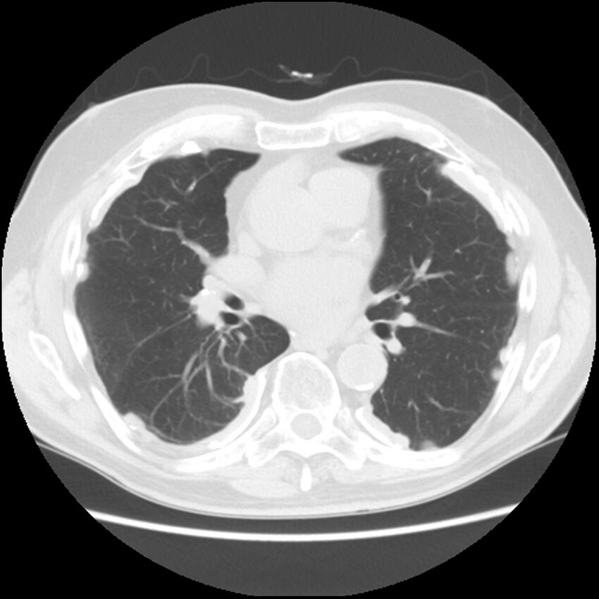 Asbestos-related pleural plaques (Radiopaedia 39069-41255 Axial lung window 39).jpg