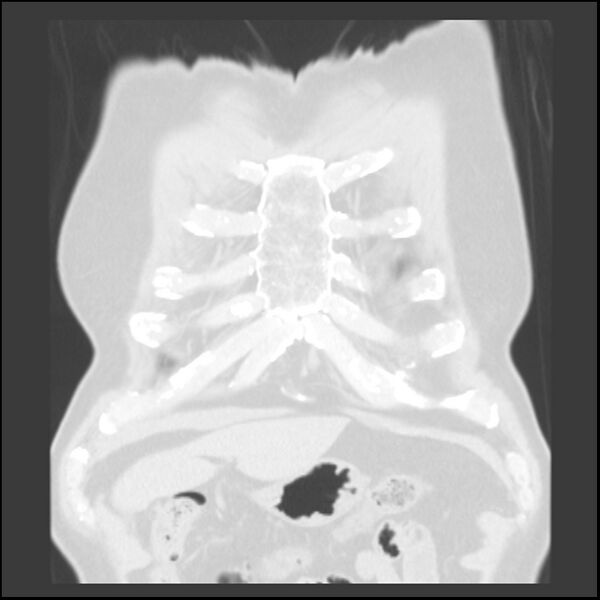 File:Asbestos-related pleural plaques (Radiopaedia 39069-41255 Coronal lung window 80).jpg