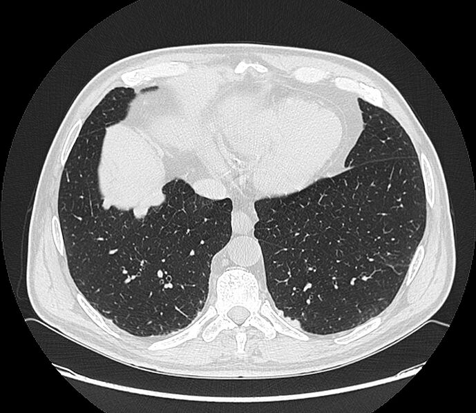 File:Asbestos pleural placques (Radiopaedia 57905-64872 Axial lung window 184).jpg