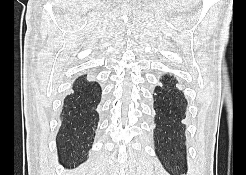 File:Asbestos pleural placques (Radiopaedia 57905-64872 Coronal lung window 265).jpg