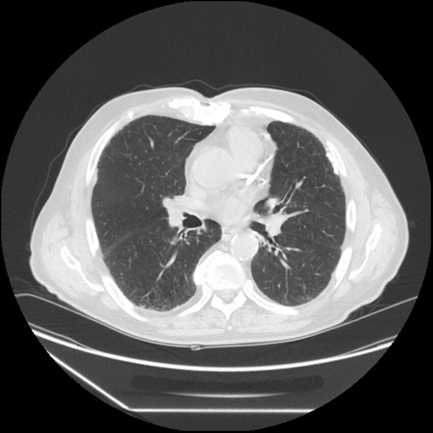 Asbestosis complicated by lung cancer (Radiopaedia 45834-50116 Axial lung window 35).jpg