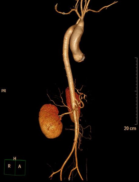 File:Ascending aortic pseudoaneurysm (Radiopaedia 28638-28910 D 4).jpg