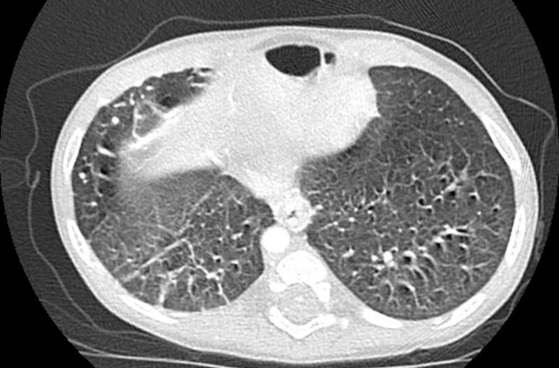 File:Asplenia syndrome (Radiopaedia 73083-83792 Axial lung window 59).jpg