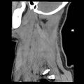 Atlanto-occipital dislocation (Radiopaedia 44648-48412 A 2).jpg