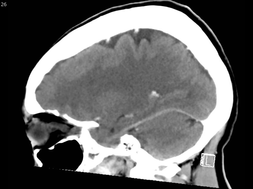 Atypical meningioma - intraosseous (Radiopaedia 64915-73867 F 25).jpg
