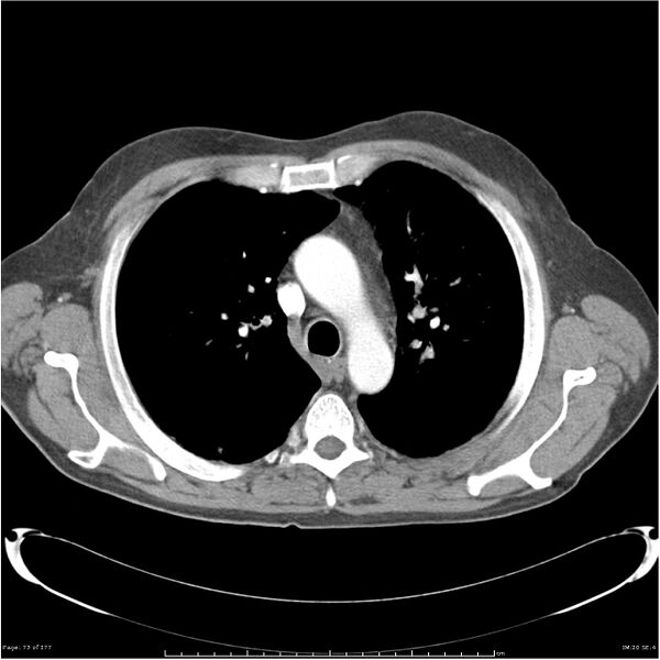 File:Atypical pneumonia - Q fever (Radiopaedia 21993-21989 C+ arterial phase 15).jpg