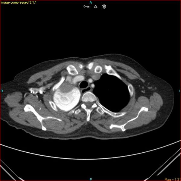 File:Azygos vein aneurysm (Radiopaedia 77824-90130 B 12).jpg