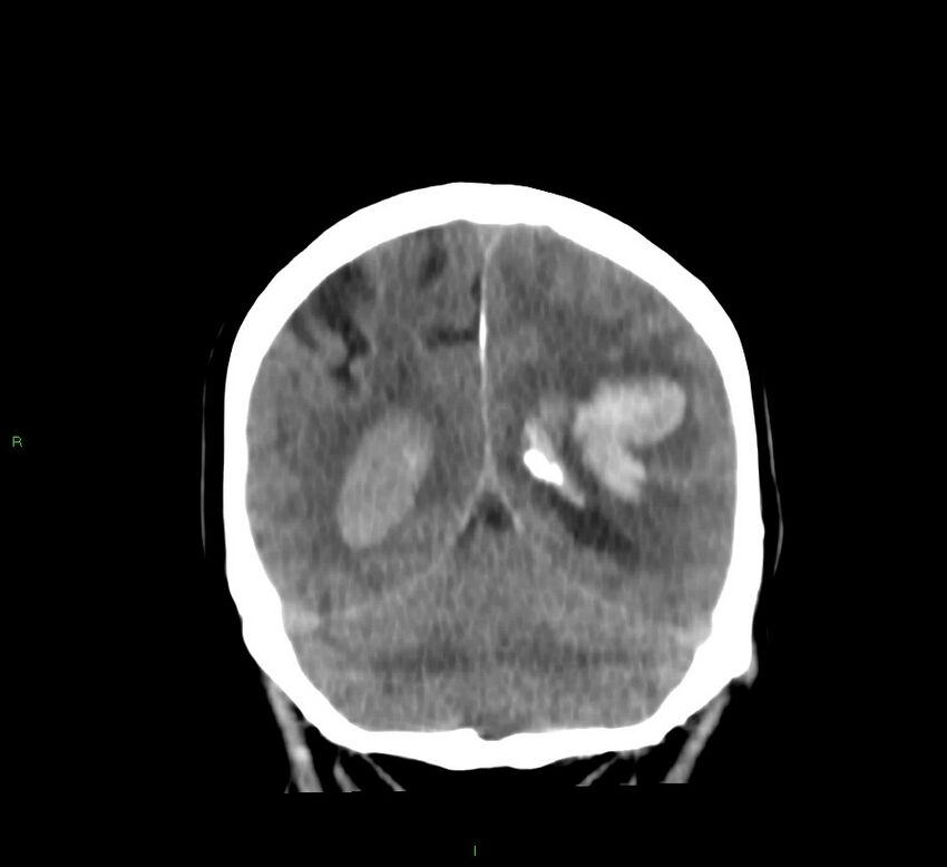 Basal ganglia hemorrhage (Radiopaedia 58767-65989 Coronal non-contrast 22).jpg