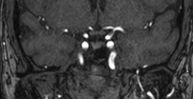 File:Basilar artery fenestration (Radiopaedia 74537-85455 Coronal MRA TOF 12).jpg