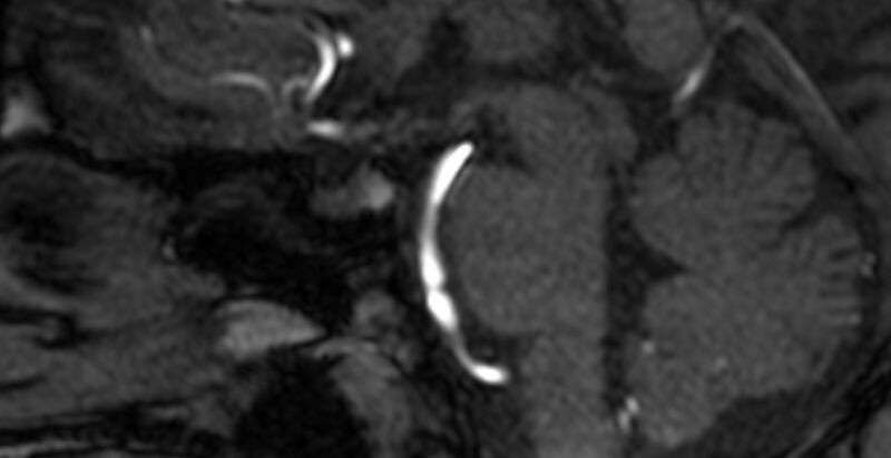 File:Basilar artery fenestration (Radiopaedia 74537-85455 Sagittal MRA TOF 17).jpg