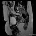 Bicornuate uterus- on MRI (Radiopaedia 49206-54297 Sagittal T2 20).jpg