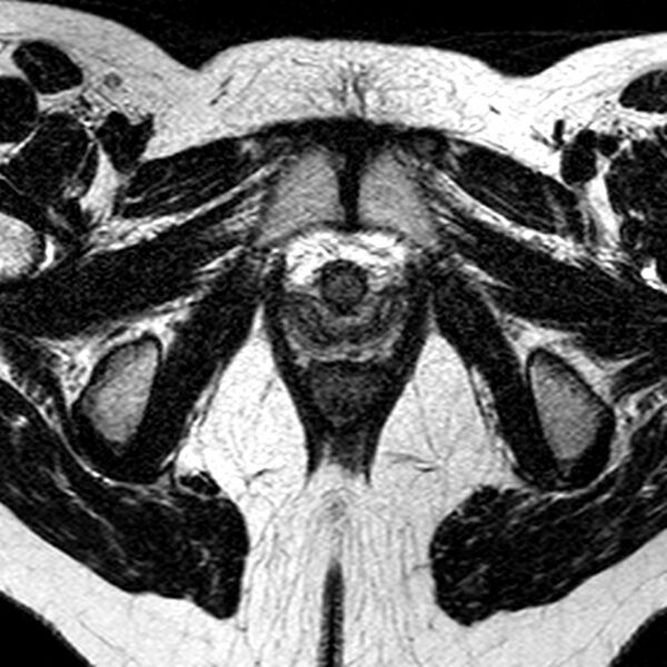 File:Bicornuate uterus (Radiopaedia 11104-11492 Axial T2 5).jpg