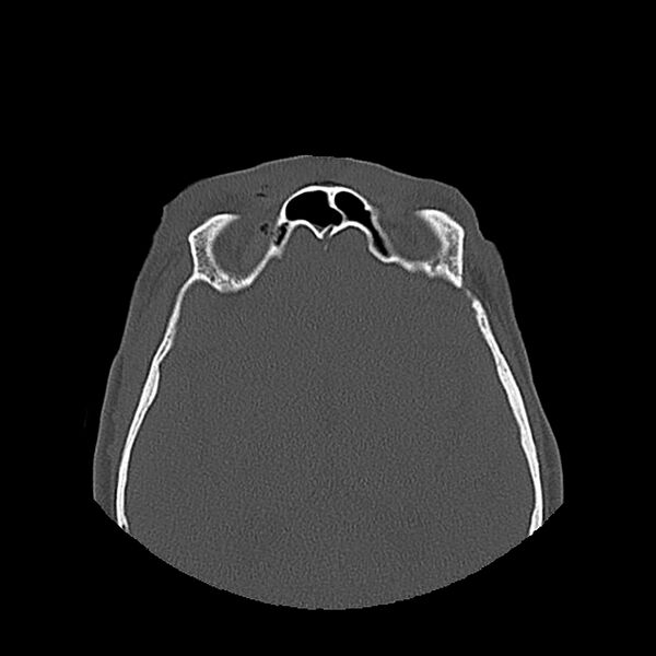 File:Bilateral Le Fort fractures (Radiopaedia 32192-33135 Axial bone window 75).jpg
