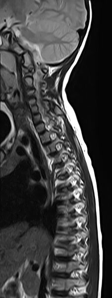 File:Bilateral Sprengel deformity with Klippel-Feil syndrome (Radiopaedia 66395-75650 Sagittal T2 4).jpg