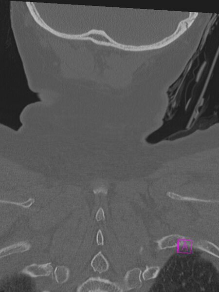 File:Bilateral atlanto-occipital assimilation (Radiopaedia 28350-28603 Coronal bone window 50).jpg