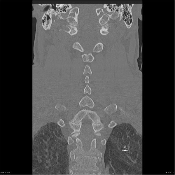 File:Bilateral cervical ribs (Radiopaedia 25868-26017 Coronal bone window 30).jpg