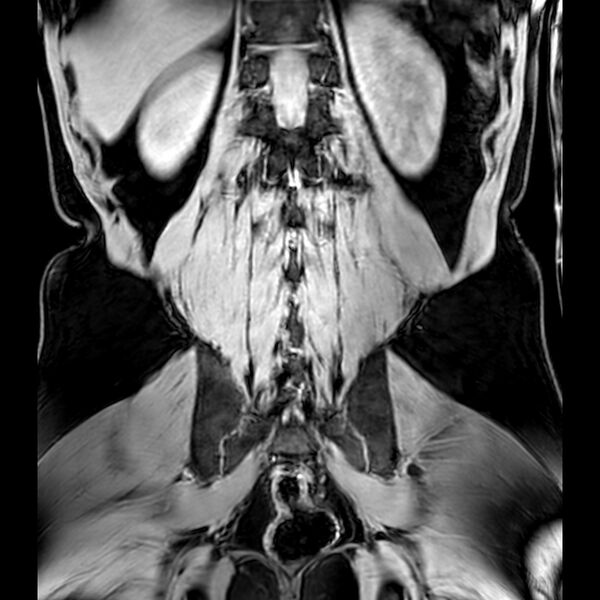 File:Bilateral conjoined nerve roots at different levels (Radiopaedia 73312-84063 Coronal WE 42).jpg