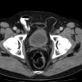 Bilateral direct inguinal herniae (Radiopaedia 17016-16719 B 18).jpg