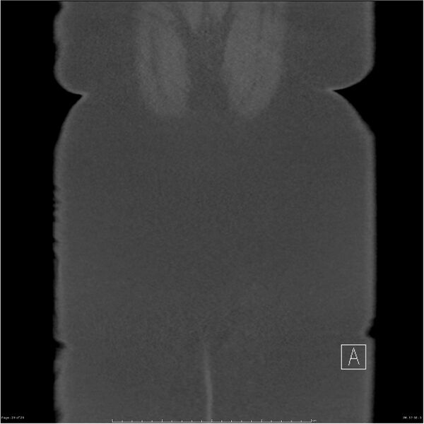 File:Bilateral lumbar ribs (Radiopaedia 25862-26010 Coronal bone window 29).jpg